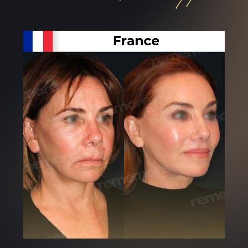 Photos Avant / Après 3